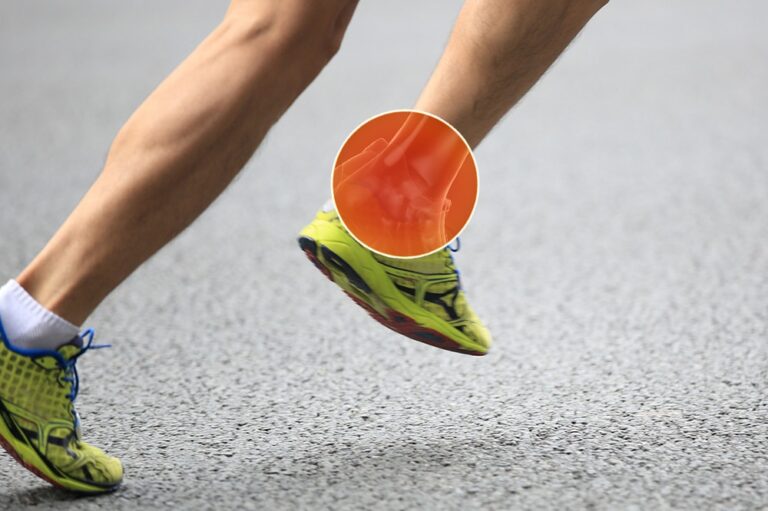 Attention Runners: Are You Treating Your Achilles Tendonitis Correctly?