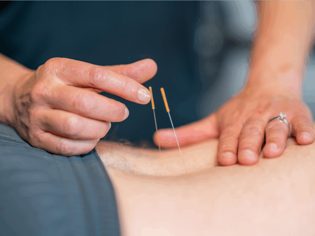 dry needling for back pain