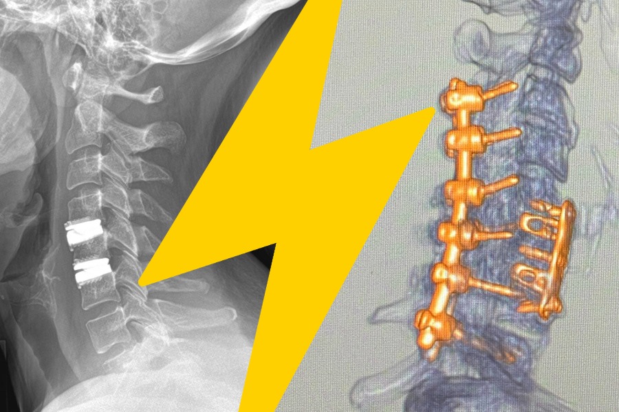 adr vs. spinal fusion