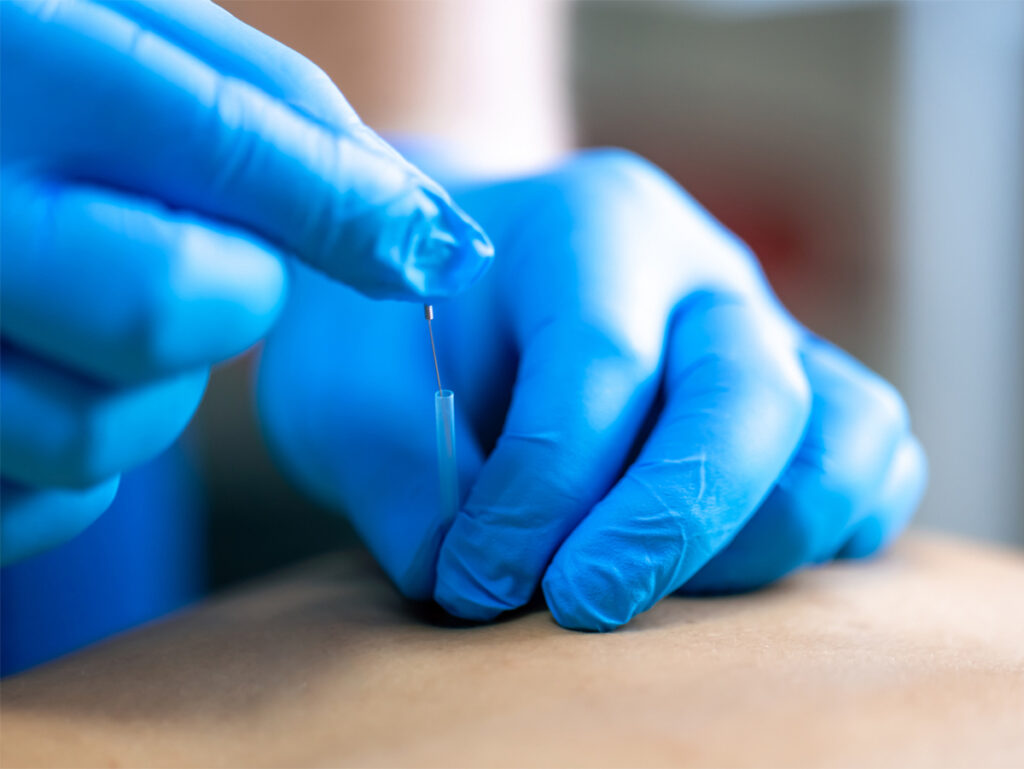 close up of a needle and hands of physical therapist doing dry needling.
