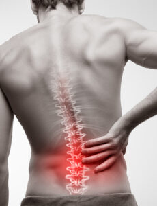 MILD Procedure for Spinal Stenosis | VSI®