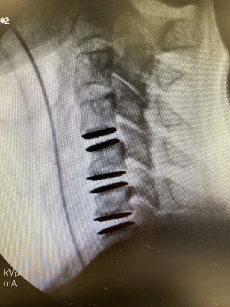 Three-level artificial disc replacement