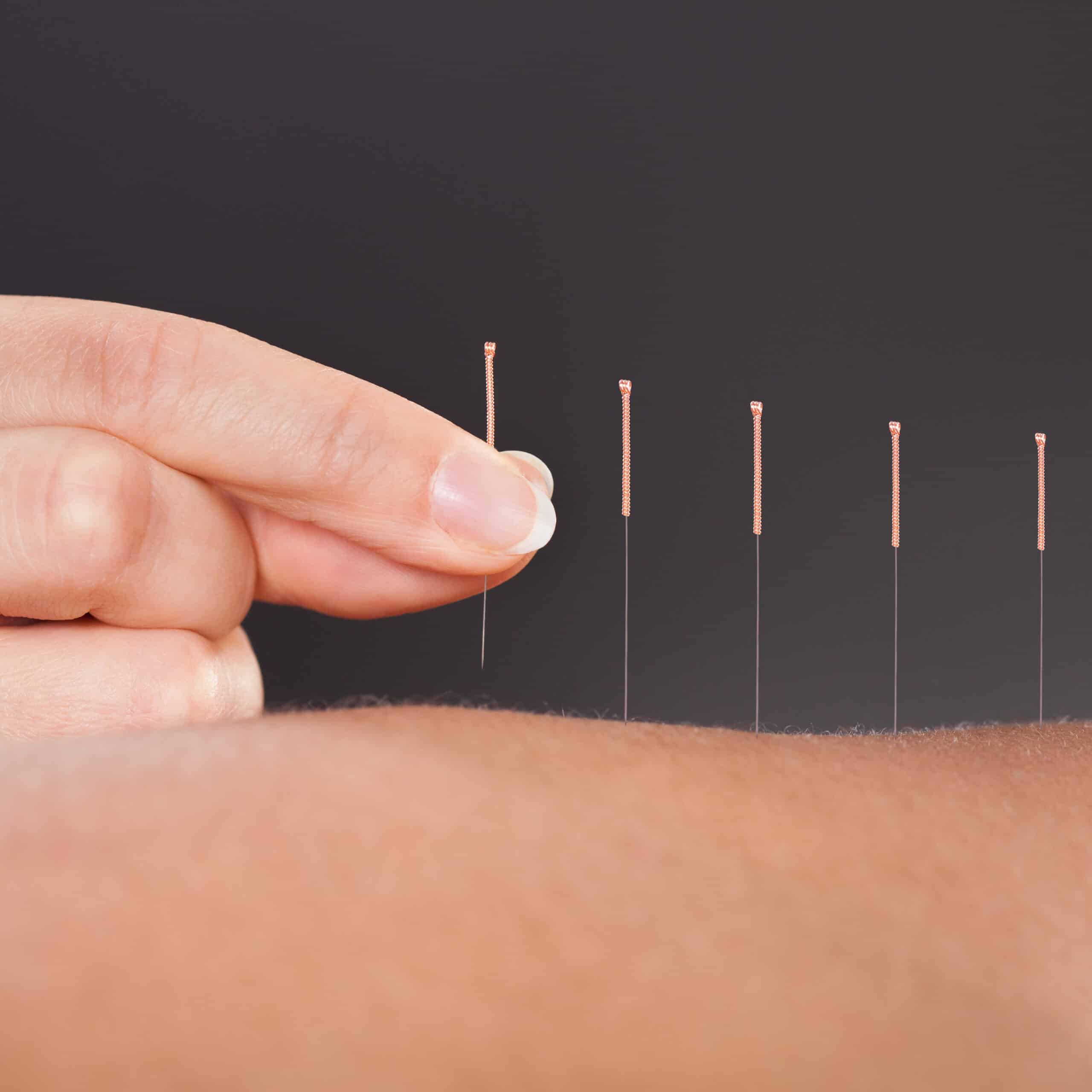 acupuncture treatment