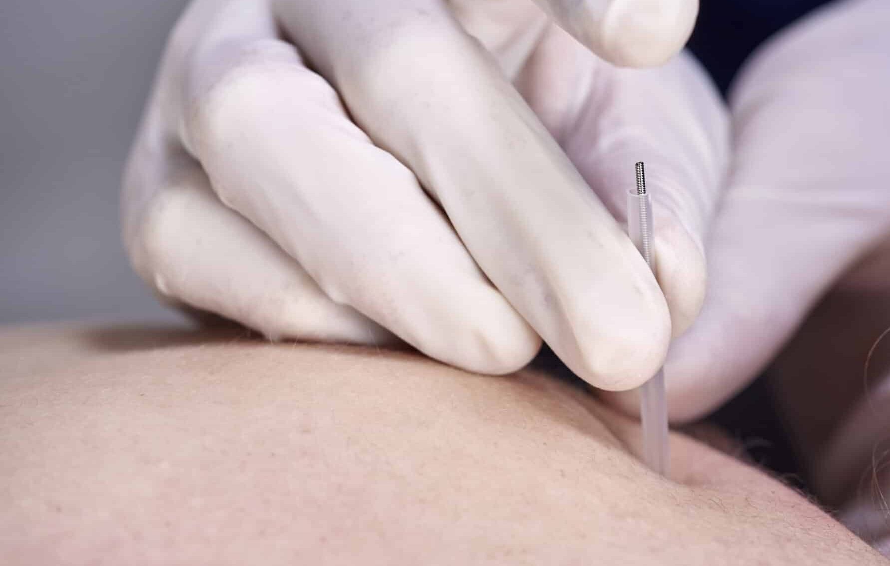 chiropractor doing dry needling, closeup of a needle and hands. physiotherapist, osteopath, manual therapy, acupressure. acupuncture, alternative medicine.