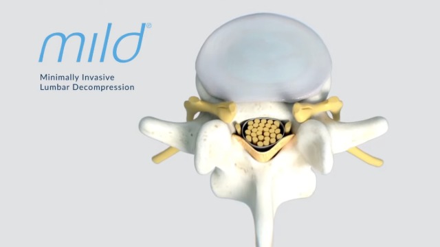 mild decompression procedure