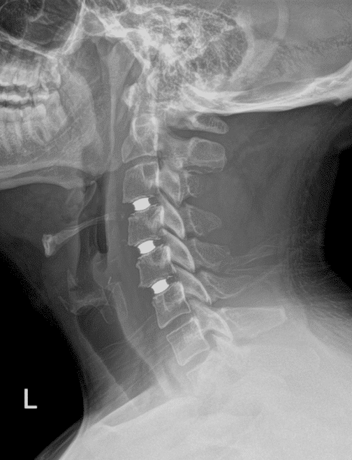 multi level disc replacement ej