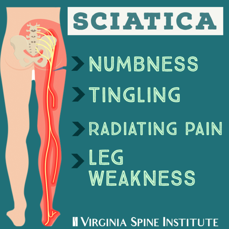 Sciatica graphic describing numbness, tingling, radiating pain, leg weakness symptoms