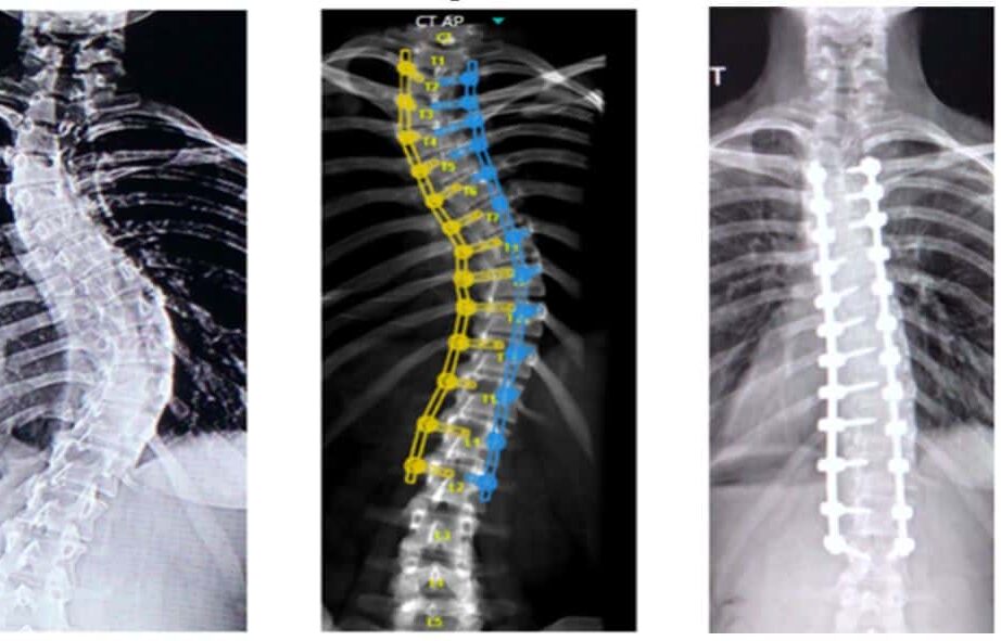 rachael's surgery xrays