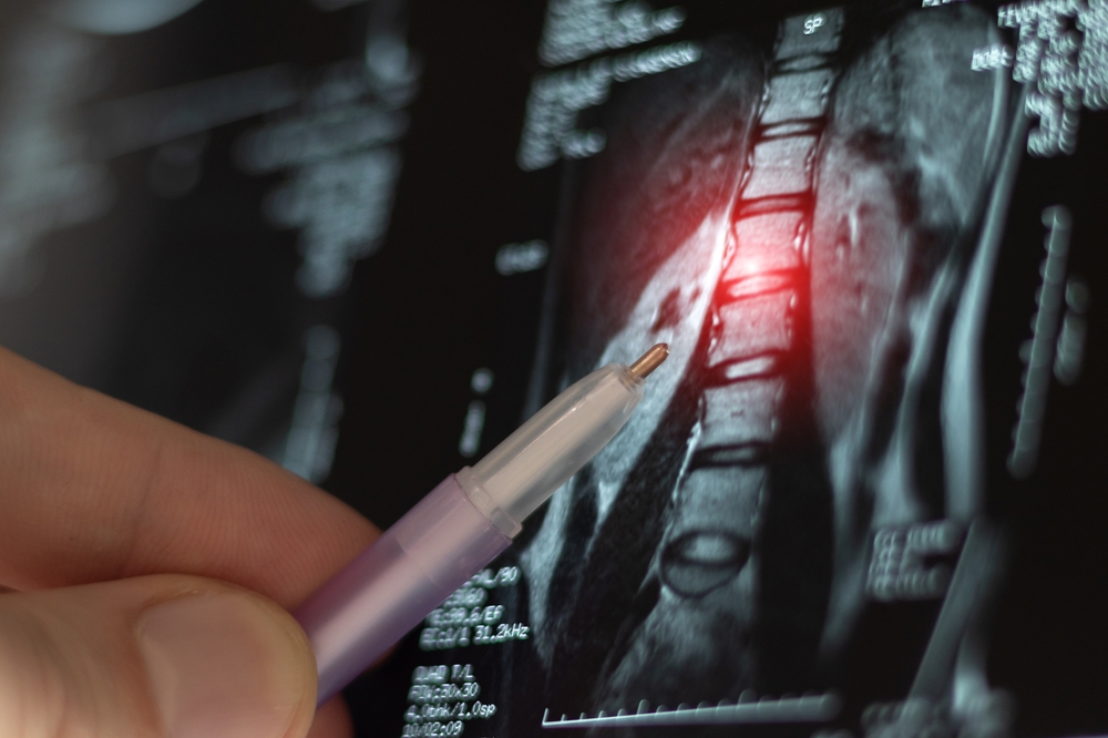 using imaging to diagnose spine levels that need treatment