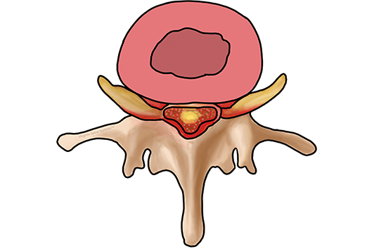 Ask The Expert: What Is Spinal Stenosis?