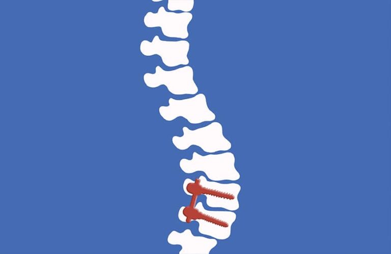 Discover The Real Truth Behind Spinal Fusions…