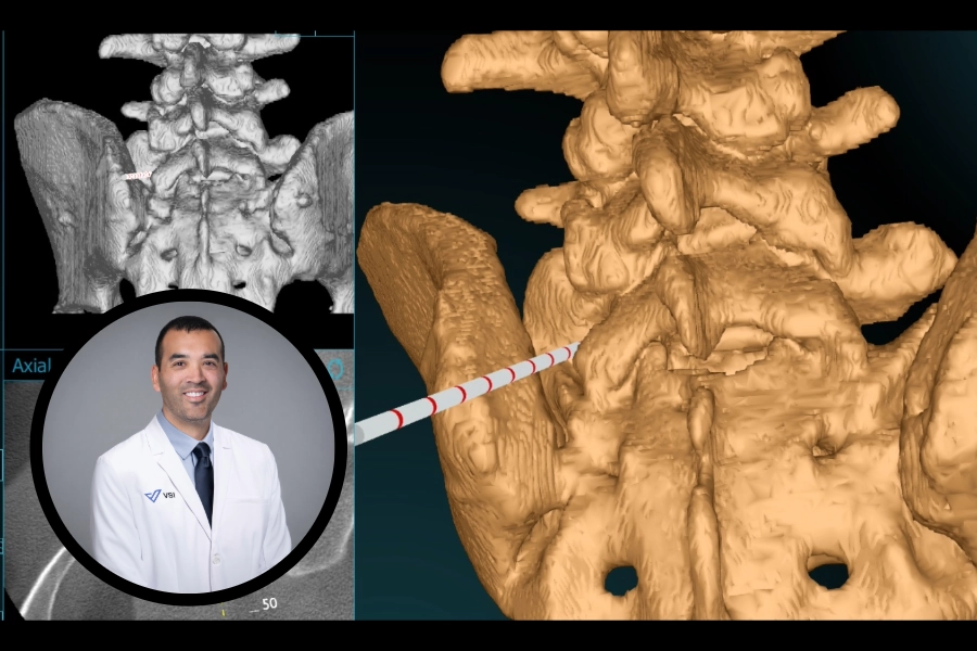 using ar for bertolotti syndrome