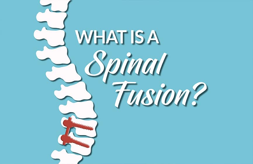 What is a Spinal Fusion graphic