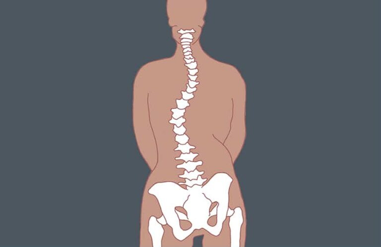 Will My Curve Worsen? Four Key Factors For Scoliosis Curve Progression